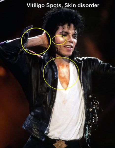 파일:Vitiligo michael.jpg